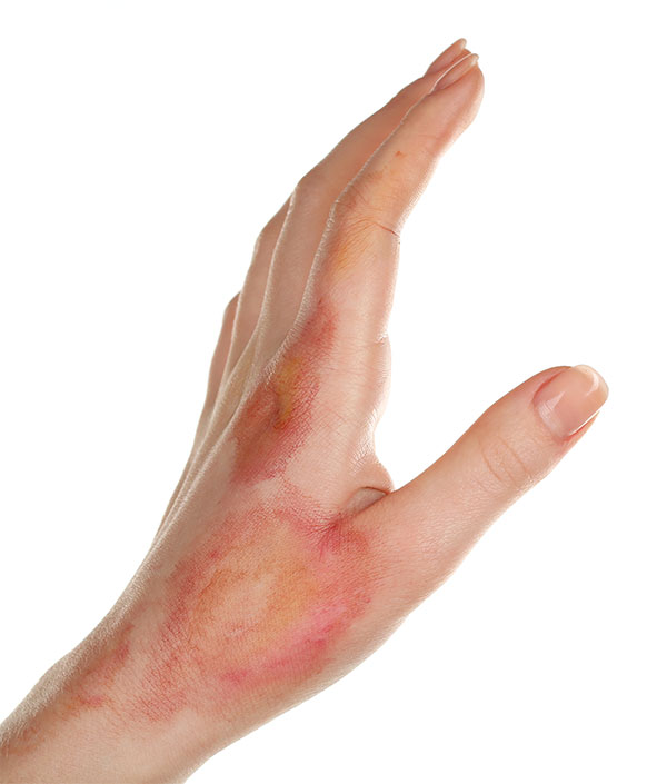 Brandwond Hand en pols